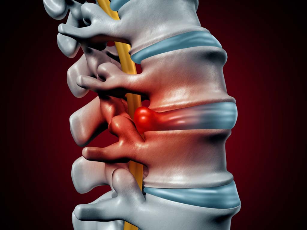Грыжа межпозвоночного диска фото